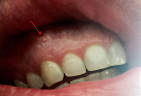 Swish a saltwater solution around in your mouth. . Hard white bump on gum reddit